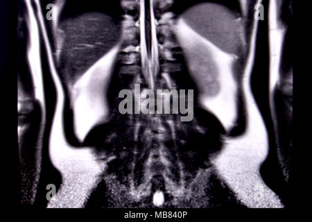 Ride through the human abdomen and chest by means of 18 MRI cuts (coronal view). Picture 14/18 Stock Photo