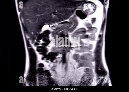 Ride through the human abdomen and chest by means of 18 MRI cuts (coronal view). Picture 1/18 Stock Photo