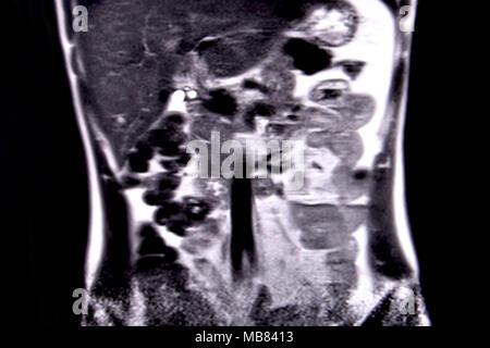 Ride through the human abdomen and chest by means of 18 MRI cuts (coronal view). Picture 2/18 Stock Photo