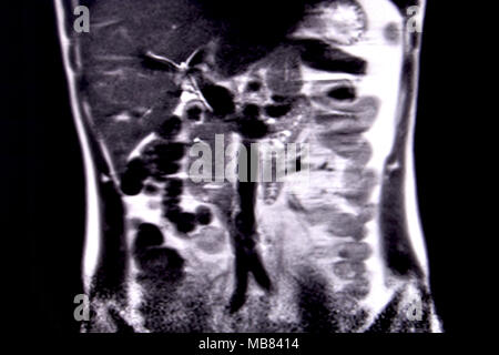 Ride through the human abdomen and chest by means of 18 MRI cuts (coronal view). Picture 3/18 Stock Photo