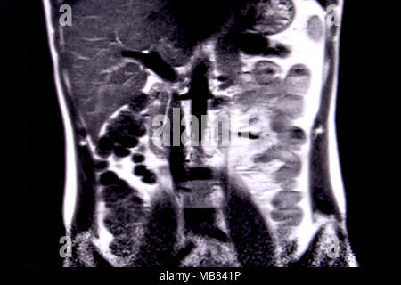 Ride through the human abdomen and chest by means of 18 MRI cuts (coronal view). Picture 4/18 Stock Photo