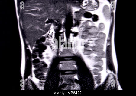 Ride through the human abdomen and chest by means of 18 MRI cuts (coronal view). Picture 5/18 Stock Photo