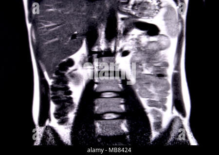 Ride through the human abdomen and chest by means of 18 MRI cuts (coronal view). Picture 6/18 Stock Photo