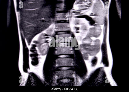 Ride through the human abdomen and chest by means of 18 MRI cuts (coronal view). Picture 8/18 Stock Photo