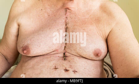 Scar from open heart surgery of coronary artery disease, where the sternum was cut in two, and the rib cage sprung. Below the scar holes show where th Stock Photo