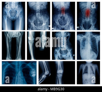 High quality collection x-ray image show many body part of human Stock Photo