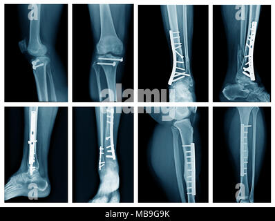 collection leg x-ray with internal fixation, high quality xray leg fracture with post operation fix bone Stock Photo