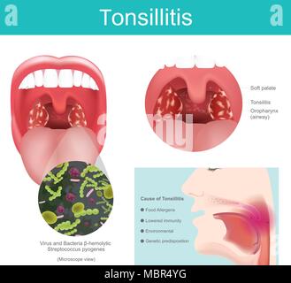Inflammation of the soft tissue in the mouth and pain in swallowing occurs. Caused by streptococcus bacterial infection including some viruses that ca Stock Vector