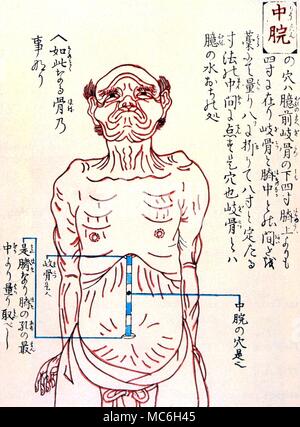 Acupuncture - Chinese acupuncture chart, from a woodcut of 1730 Stock Photo