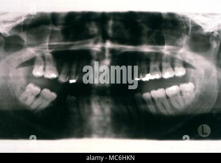 Medical -X-Ray of the human jaw Stock Photo