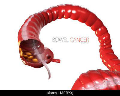 Colorectal cancer, malignant tumor in intestine, Endoscope inside ...