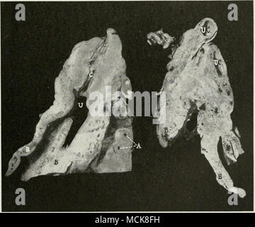 . Fig. 179—Septic Metritis, Uterus of Cow, with Great Thickening of ...