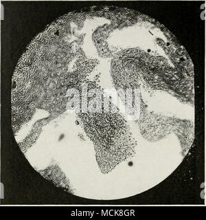 . Fig. 151—Highly Magnified Fold of the Mucosa in Chronic Catarrhal Inflammation. Showing Destruction of the Epithelium, thickening by newly-formed Connective Tissue, and Amyloid or Hyaline Infiltration of the Blood Vessels. Stock Photo
