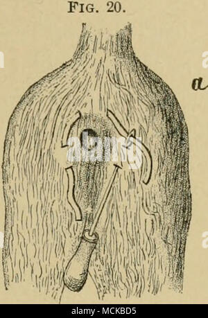 tobacco stitching stitching rectum (tobacco- bag stitch) : n, method of stitching ; h, stitch  tied. After replacing the intestine it is generally necessary to place a  stitch around the perineum, so as