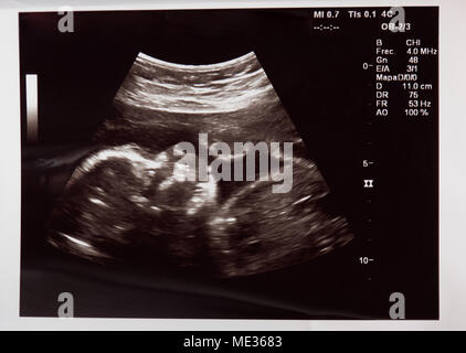 Baby head on ultrasound scan in hospital check Stock Photo