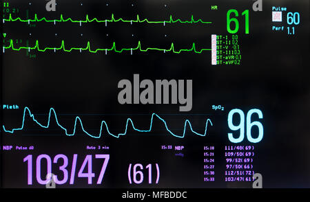 Monitor with ECG with paced heart rhythm, arterial blood pressure ...