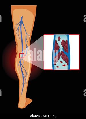 Medical Image of Varicose Veins illustration Stock Vector