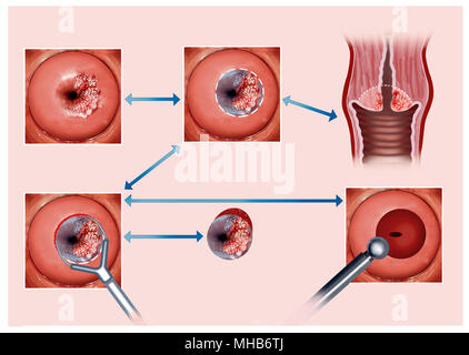 Illustration describing the process of cauterization of the cervix affected by cancer Stock Photo