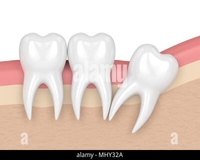 3d render of teeth with wisdom distal impaction. Concept of different types of wisdom teeth impactions. Stock Photo