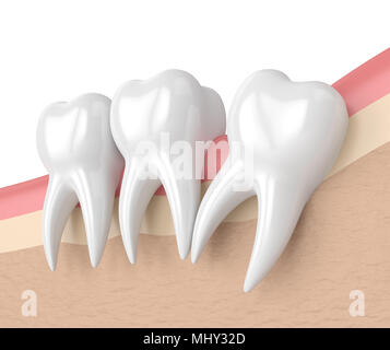 3d render of teeth with wisdom distal impaction. Concept of different types of wisdom teeth impactions. Stock Photo