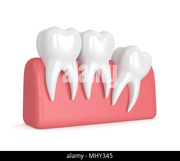 3d render of teeth with wisdom distal impaction over white background. Concept of different types of wisdom teeth impactions. Stock Photo