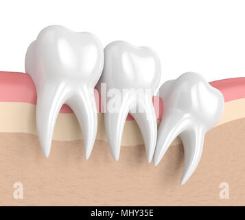 3d render of teeth with wisdom distal impaction. Concept of different types of wisdom teeth impactions. Stock Photo