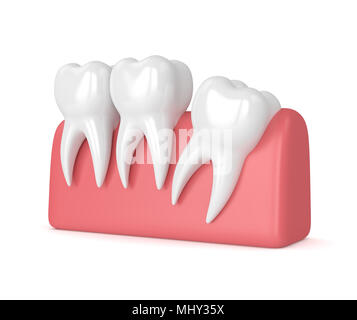 3d render of teeth with wisdom distal impaction over white background. Concept of different types of wisdom teeth impactions. Stock Photo