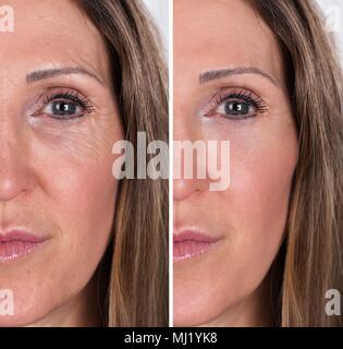 Photo Of Anti-aging Procedures On Caucasian Woman Face Stock Photo
