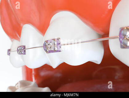 Teeth with braces or brackets in open human mouth - 3d rendering Stock Photo