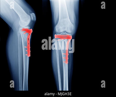 fracture tibia bone and post operation fixation anterior and lateral view x-ray Stock Photo