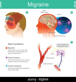 Migraine. Headache, pain, tend cooccur on one side of the head Pressured blood vessels reduce blood flow for brain. Illustration. Stock Vector