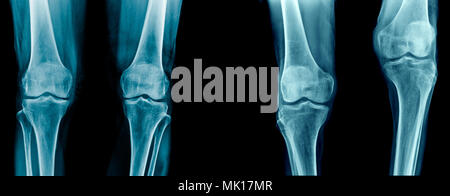 collection of knee joint, knee joint pain x-ray set, high qaulity knee joint and tibia, femur bone Stock Photo