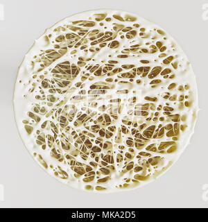 Cross section of an advanced osteoporosis -high details - Stage 4 - 3d ...