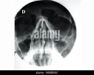 SINUS, X-RAY Stock Photo