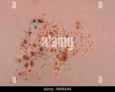 CUTANEOUS HAMARTOMA Stock Photo - Alamy