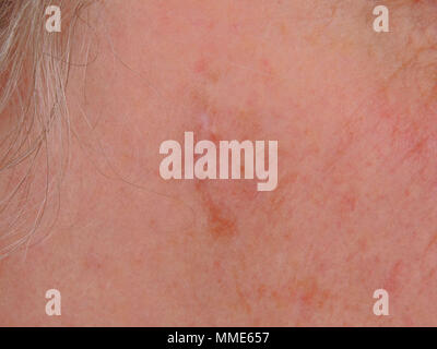 LENTIGO MALIGNA MELANOMA Stock Photo - Alamy