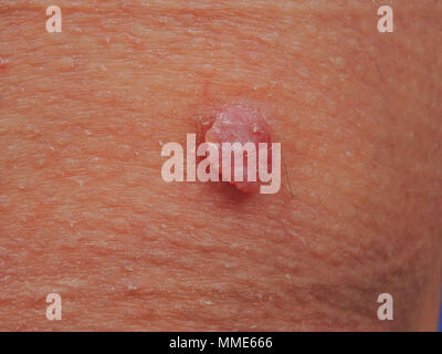 Pyogenic granuloma. Close-up of a pyogenic granuloma on the skin of a ...