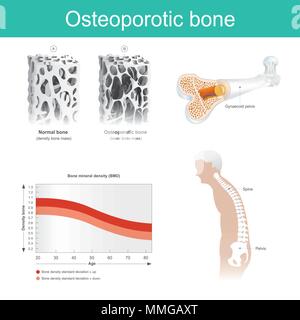 This is a disease in which the density and quality of bone are reduced. The old man's health deteriorated because from the lack of calcium. Stock Vector