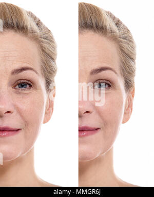 Middle aged woman face before and after cosmetic procedure. Plastic surgery concept. Stock Photo