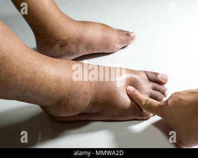 The feet of people with diabetes, dull and swollen. Due to the toxicity of diabetes placed on a white background. Fingers hit the back of the diabetic Stock Photo