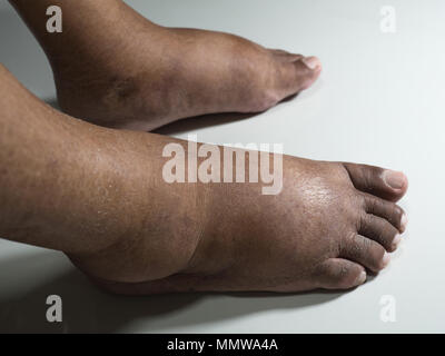 The feet of people with diabetes, dull and swollen. Due to the toxicity of diabetes placed on a white background. Stock Photo