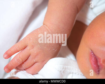 Closeup hand of a newborn with a skin peeling on white cloth. Skin allergies in newborn called Vernix. the concept of health care and medical. Stock Photo