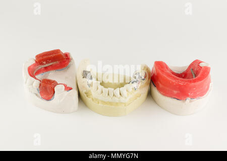 wax rollers on the tooth model for determining jaw closure Stock Photo