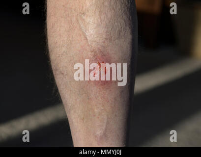 Open lower leg wound with cellulitis infection Stock Photo