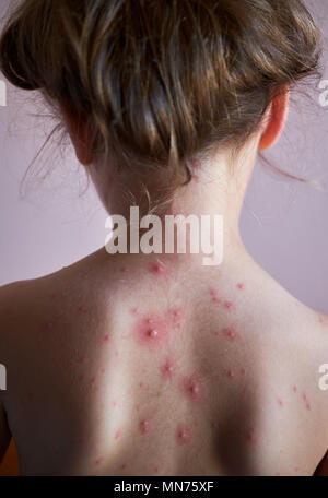 Upper back of young woman contracted chickenpox and red rash