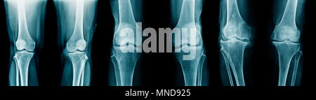 collection knee x-ray image Stock Photo