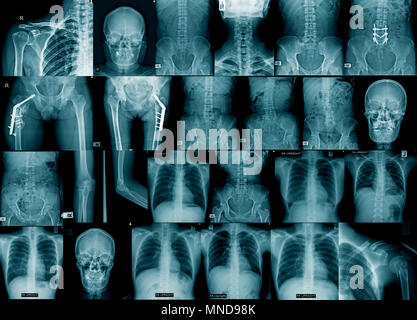 collection x-ray image chest, skull, hip replacement, spine fracture and fixed Stock Photo