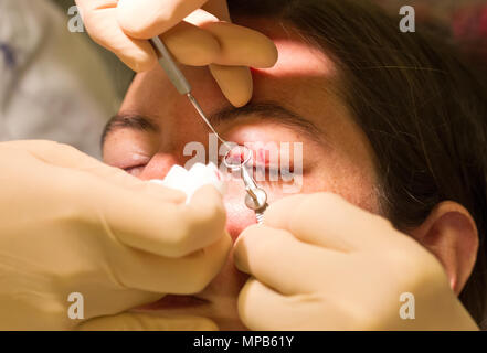 Healthcare concept - Chalazion during eye examination and operation - Female Stock Photo