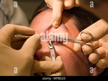 Healthcare concept - Chalazion during eye examination and operation - Female Stock Photo