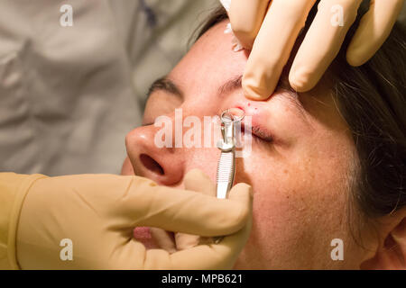 Healthcare concept - Chalazion during eye examination and operation - Female Stock Photo